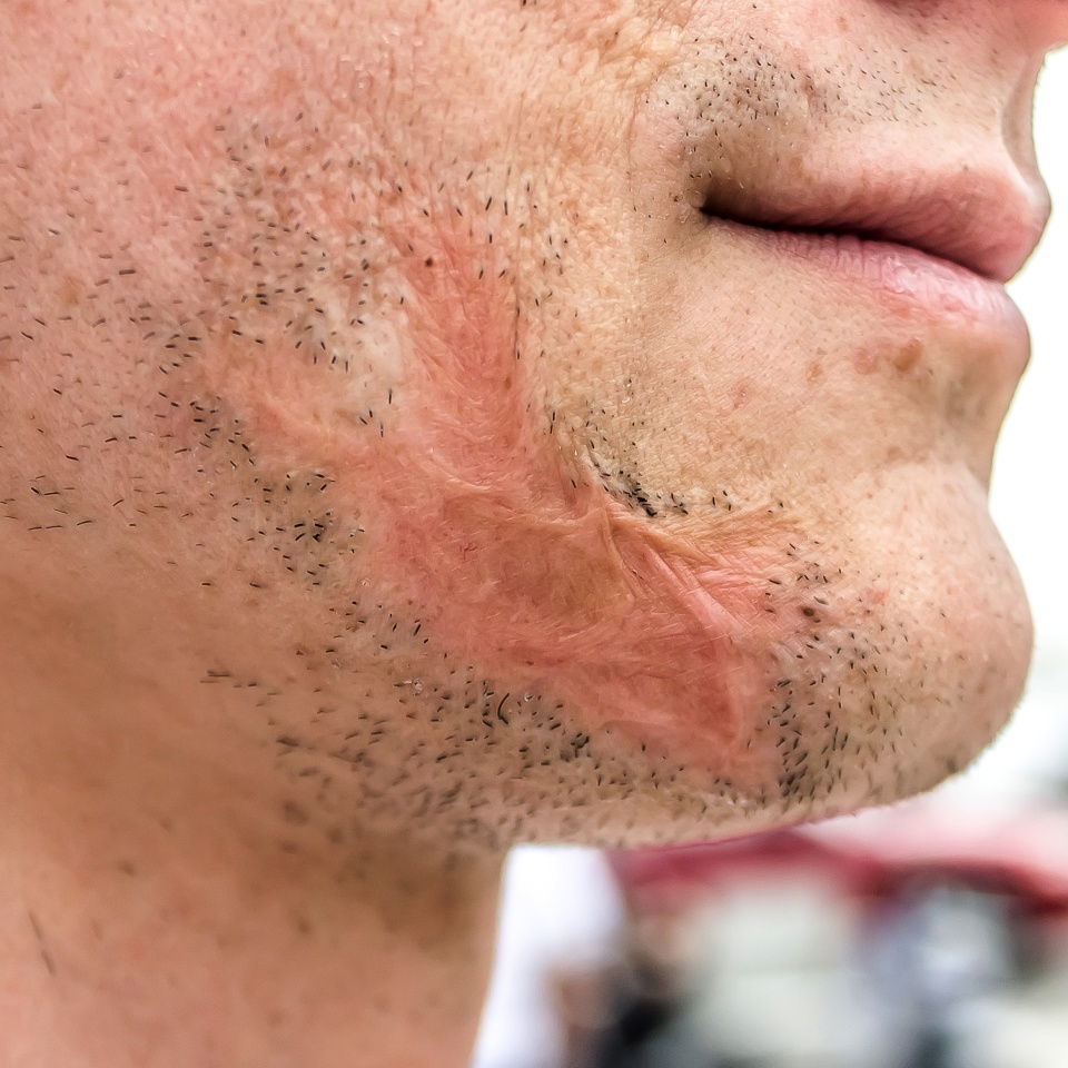 Scar from burn on face men