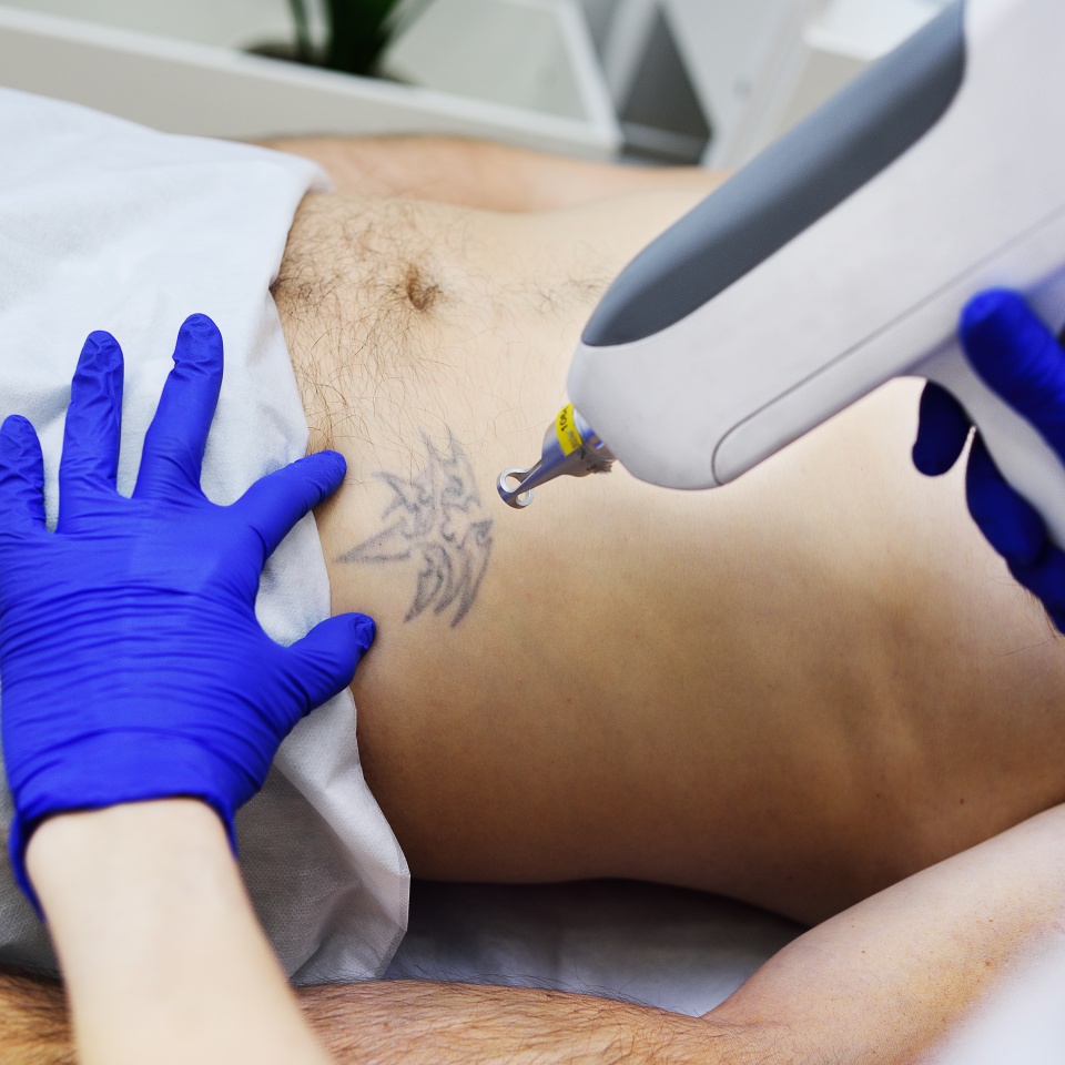 Cosmetologist doctor removes tattoo patient man professional laser. Laser cosmetology
