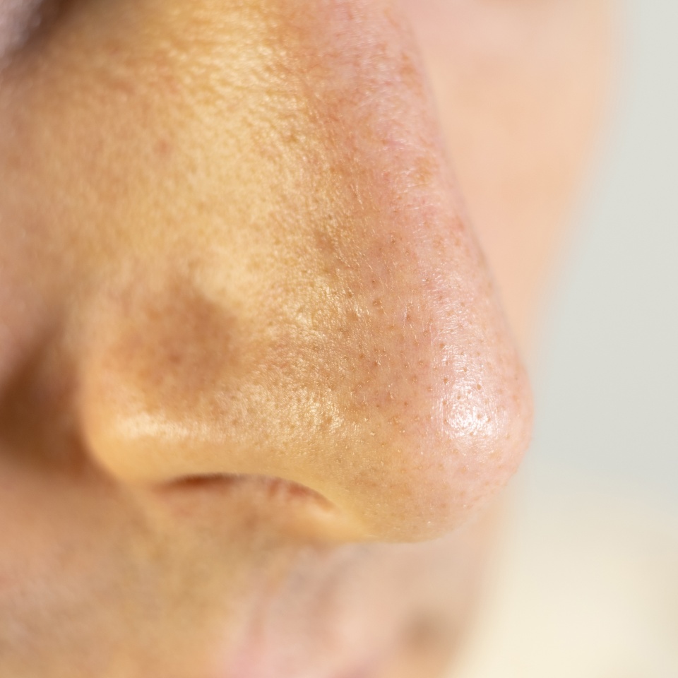 Blackheads on mans nose. Acne problem, comedones. Close up.