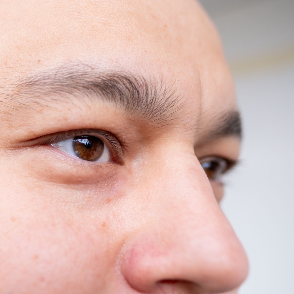 Closeup portrait man with brown eyes and shaved head, white background, male baldness and growing need professional hair restoration, natural skin texture, intensity glance, human forehead