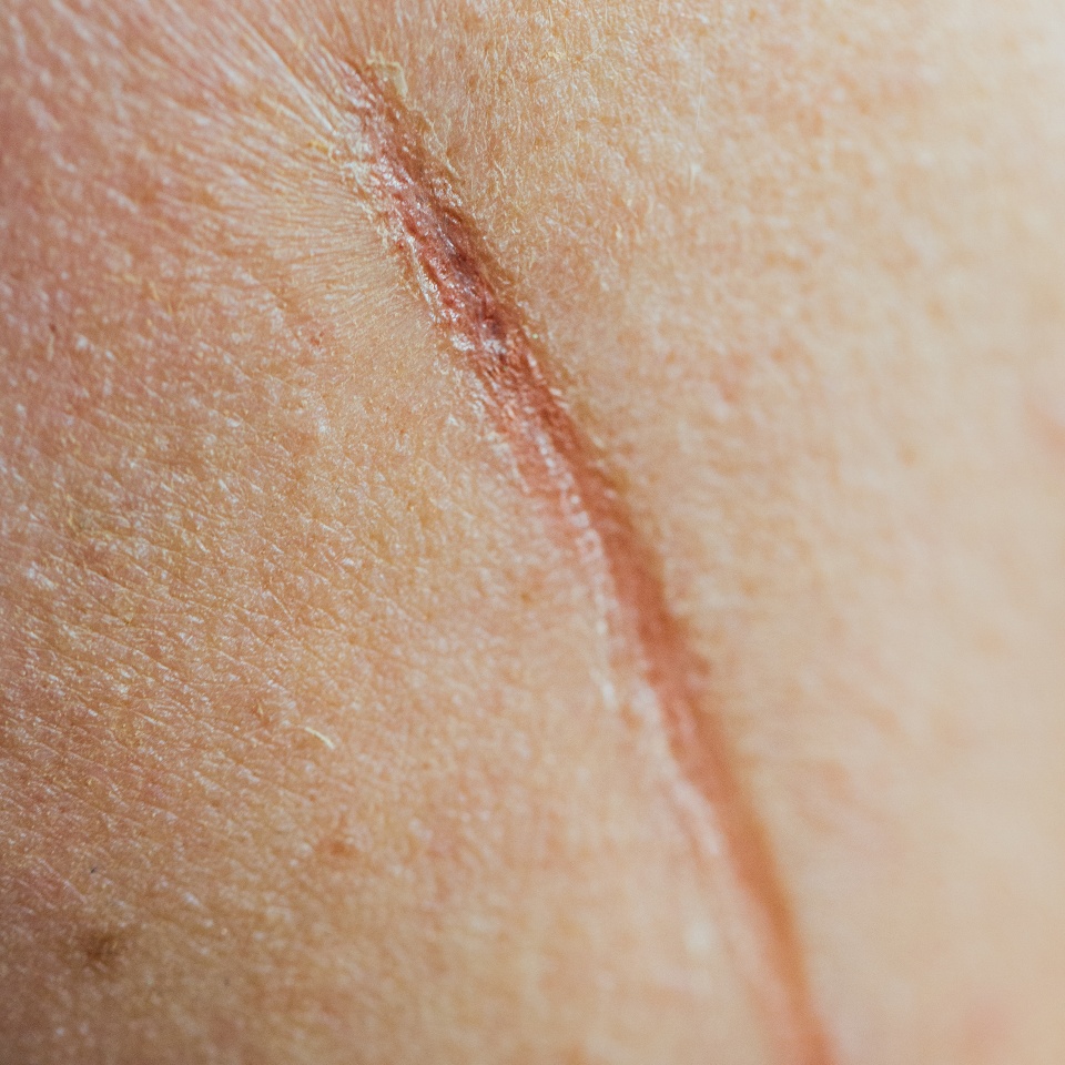 large scar on on face the cheek of a man. Mangle, wound, cut of a knife. Unrecognizable, close macro.